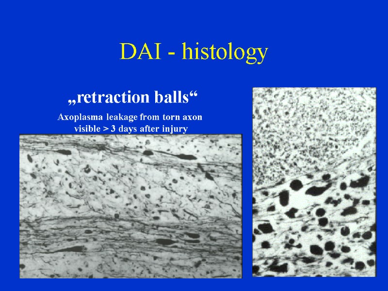 DAI - histology         „retraction balls“ Axoplasma